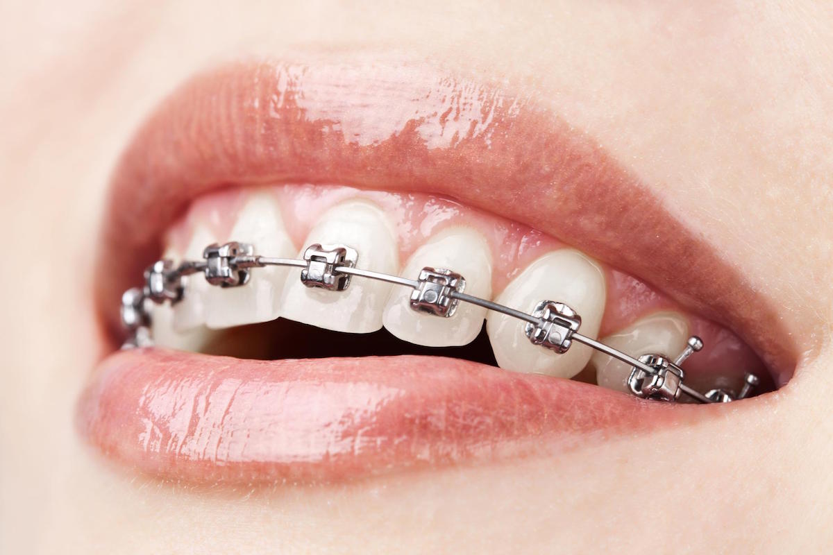 best orthodontics norlane in geelong