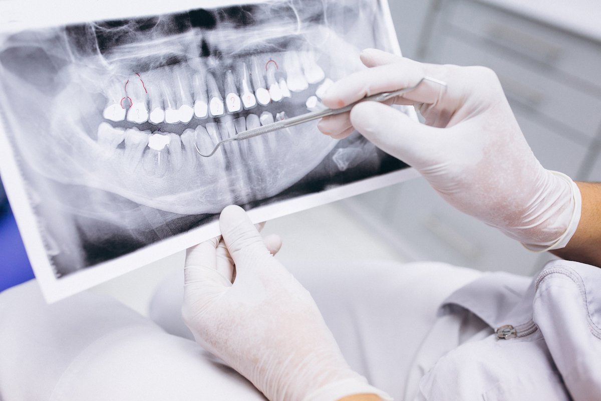 intraoral x-rays norlane