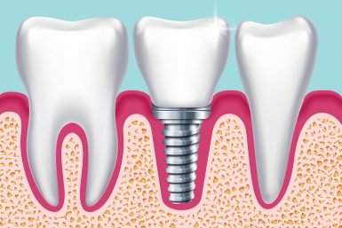 Human teeth and dental implant in jaw orthodontist medical vector illustration