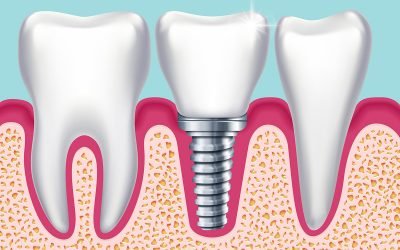 Dental Tips: What are the replacement options for missing teeth?