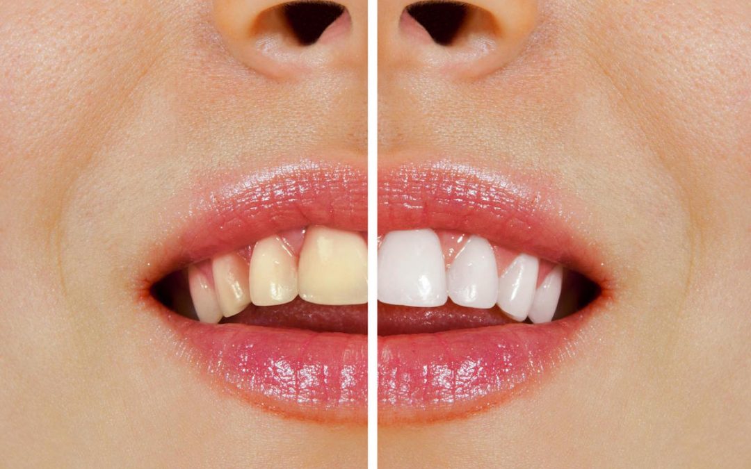 Dental Tips: Over-the-Counter Whitening vs Professional Teeth Whitening