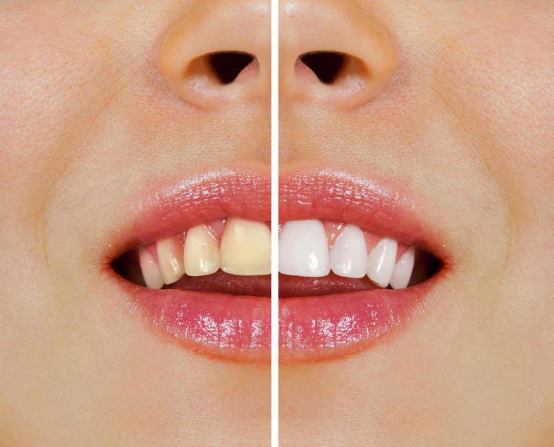 Dental Tips OvertheCounter Whitening vs Professional Teeth Whitening