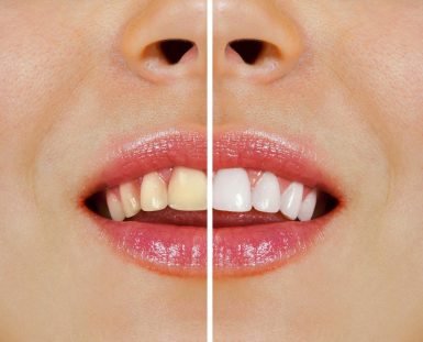 Norlane Dentist Tips Over-the-Counter Whitening vs Professional Teeth Whitening