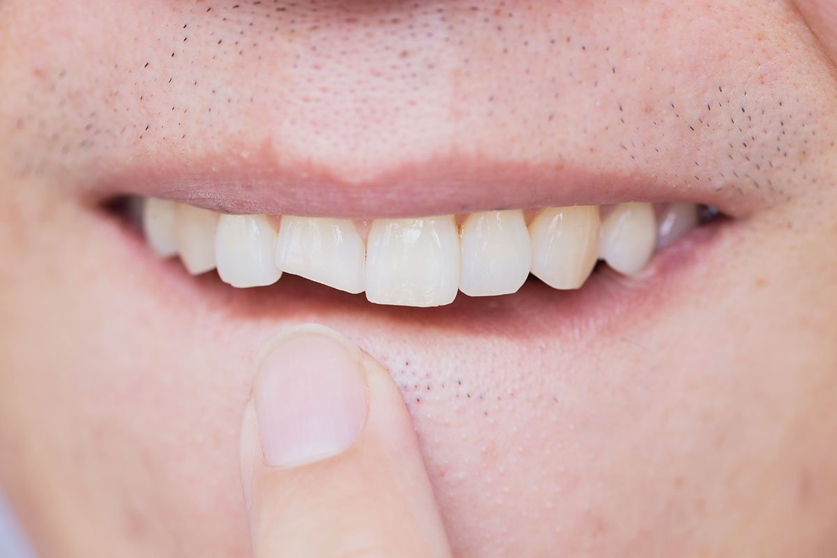 Soft Tissues Injuries in the Mouth Norlane Dental Surgery