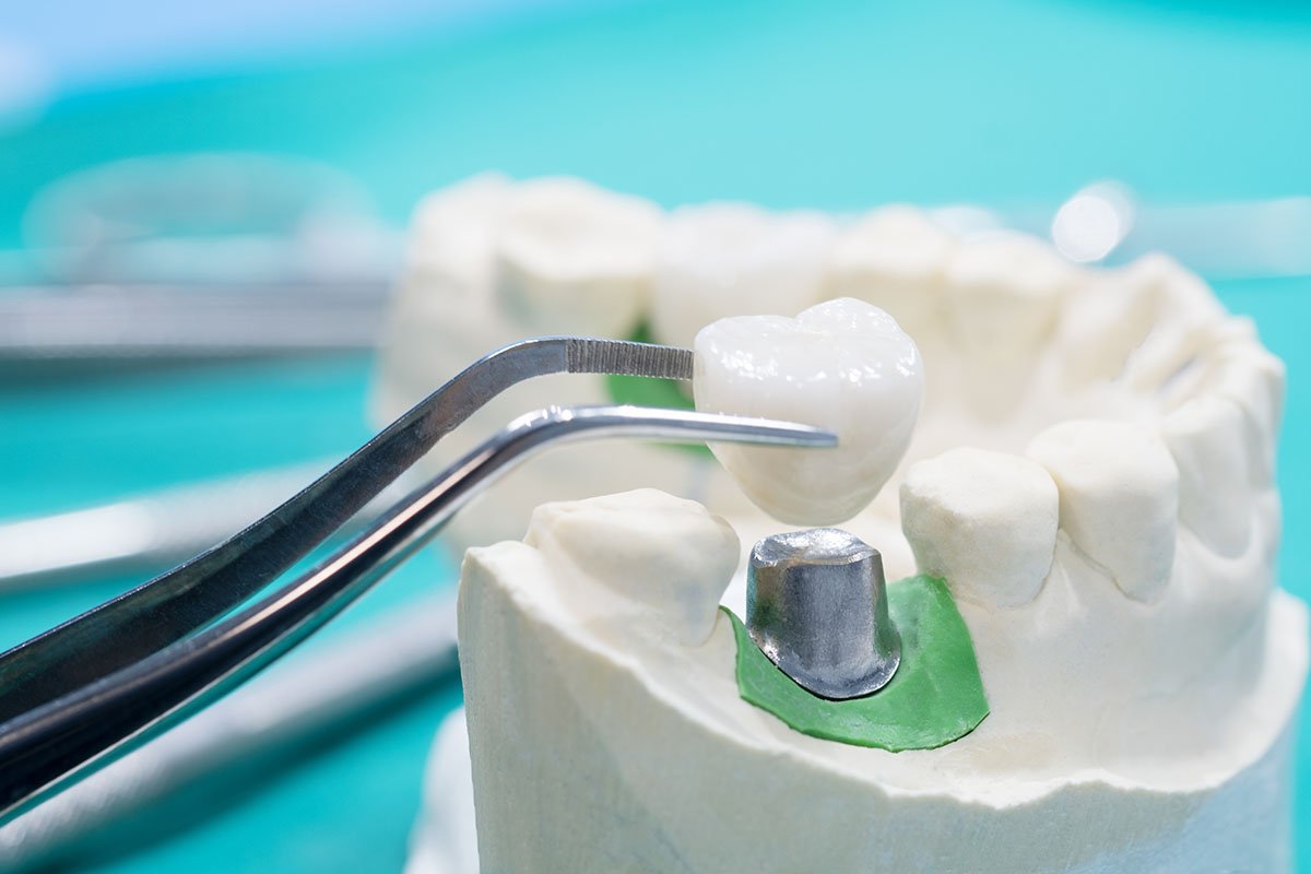 lost restoration or filling - dental emergency