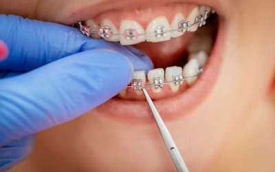 Can I Get Braces with Missing Teeth?