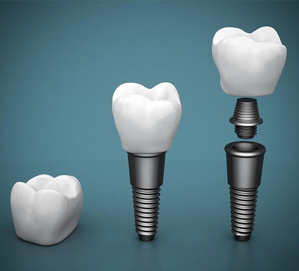 dental implants norlane