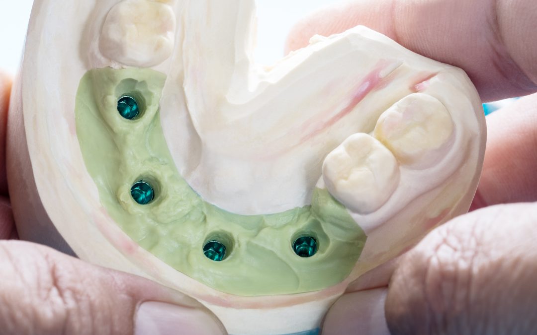 Dental Tips: What are All-on-4 Dental Implants and When Do I Need Them?