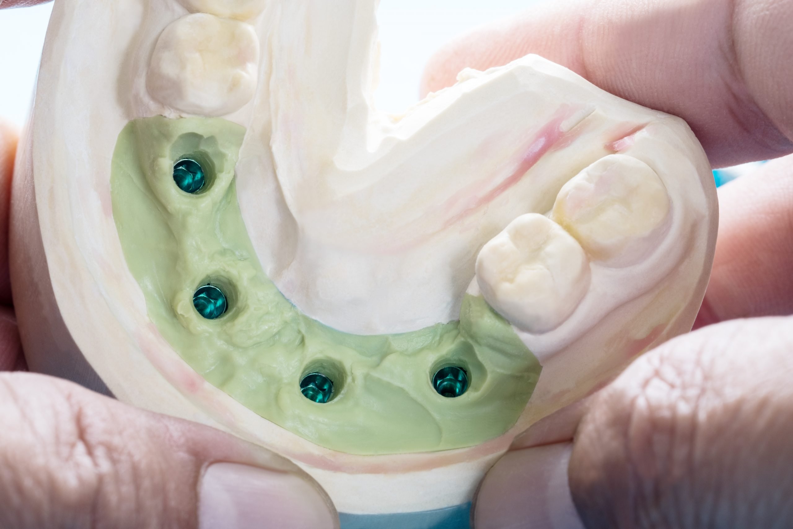 Featured image for “Dental Tips: What are All-on-4 Dental Implants and When Do I Need Them?”
