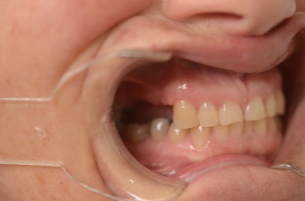 family dental implants Norlane  Geelong