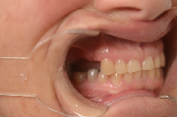 family dental implants Norlane Geelong