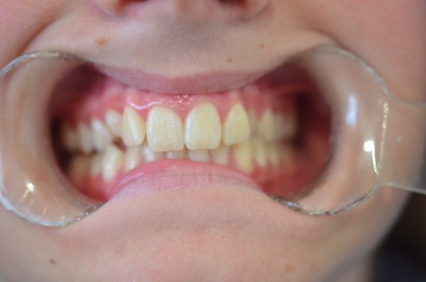 orthodontics case 1 before norlane geelong