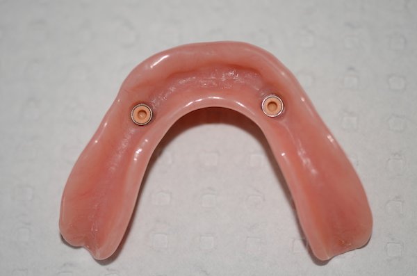 dental implants in norlane Geelong