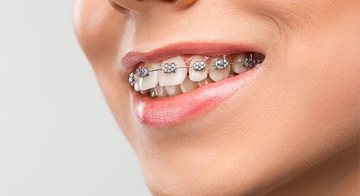 braces care norlane geelong