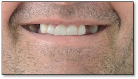 crown and implants case 1 image 1 dentist norlane geelong