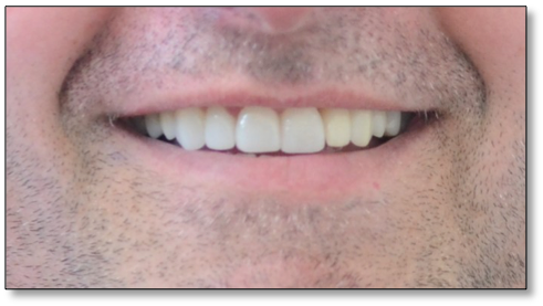 crown and implants case 1 image 2 dentist norlane geelong