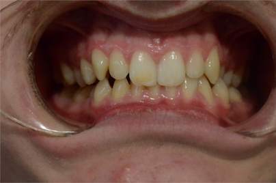 orthodontics case 5 image 3 dentist norlane geelong