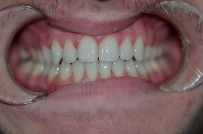 orthodontics case 5 image 4 dentist norlane geelong