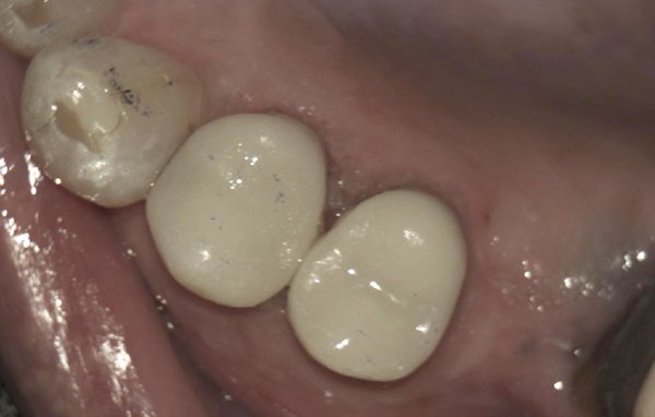 same-day cerec crowns case 1 image 2 dentist norlane