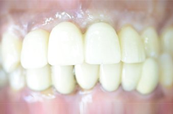 smile designing case 4 image 2 dentist norlane