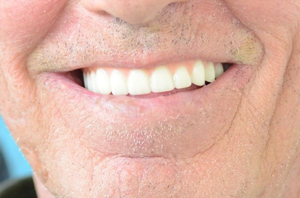 mark all on 4 fixed bridge after dentist norlane geelong