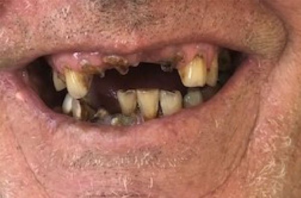 mark all on 4 fixed bridge before dentist norlane geelong