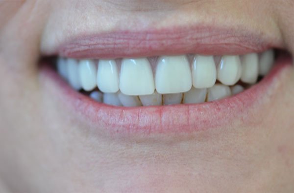 mary fixed bridge on 6 implants after dentist norlane geelong