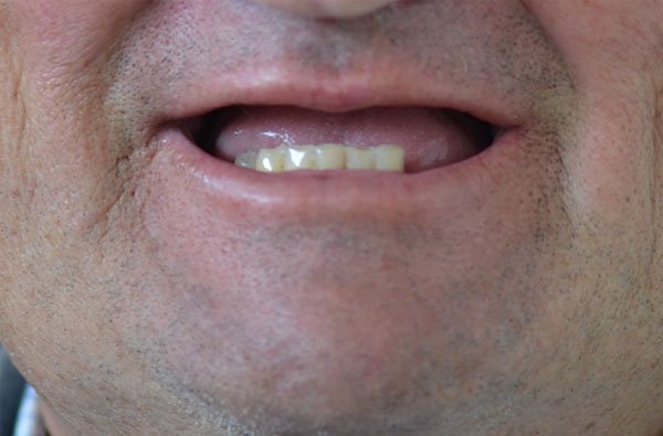 peter fixed on 4 before dentist norlane geelong