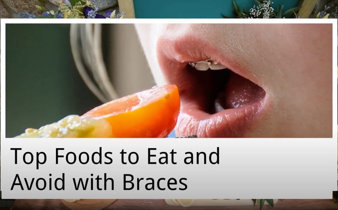 Top Foods to Eat and Avoid with Braces from Norlane Dental Surgery