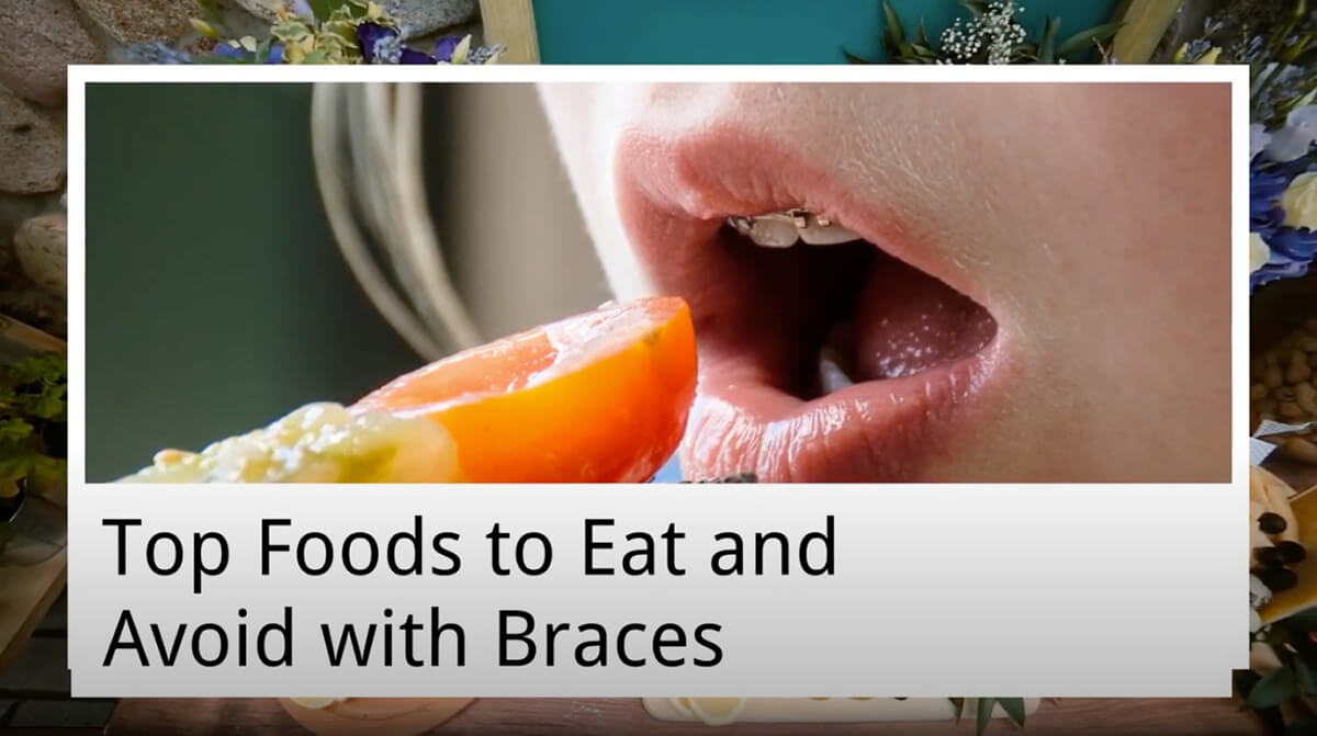Featured image for “Top Foods to Eat and Avoid with Braces from Norlane Dental Aesthetics and Implants”