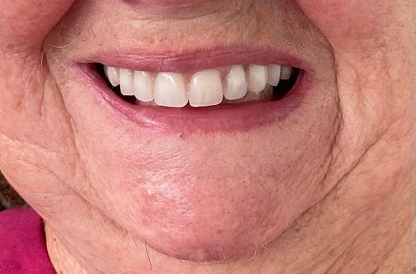 all-on-4 implants case 7 after dentist norlane geelong