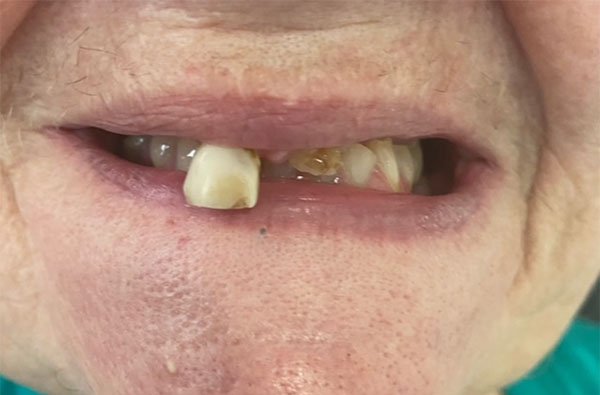 all-on-4 implants case 7 before dentist norlane geelong