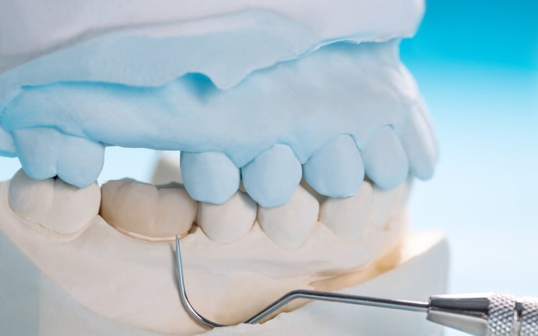 How Long Will Dental Crowns Last? Answers from Norlane Dental Surgery