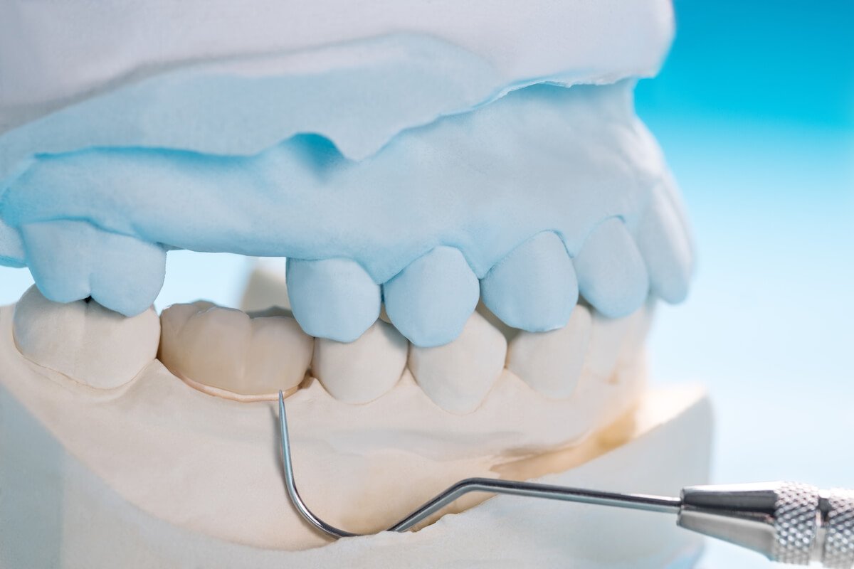 Featured image for “How Long Will Dental Crowns Last? Answers from Norlane Dental Aesthetics and Implants”