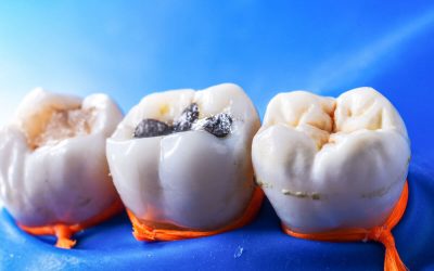 How to Choose the Best Dental Fillings in Norlane