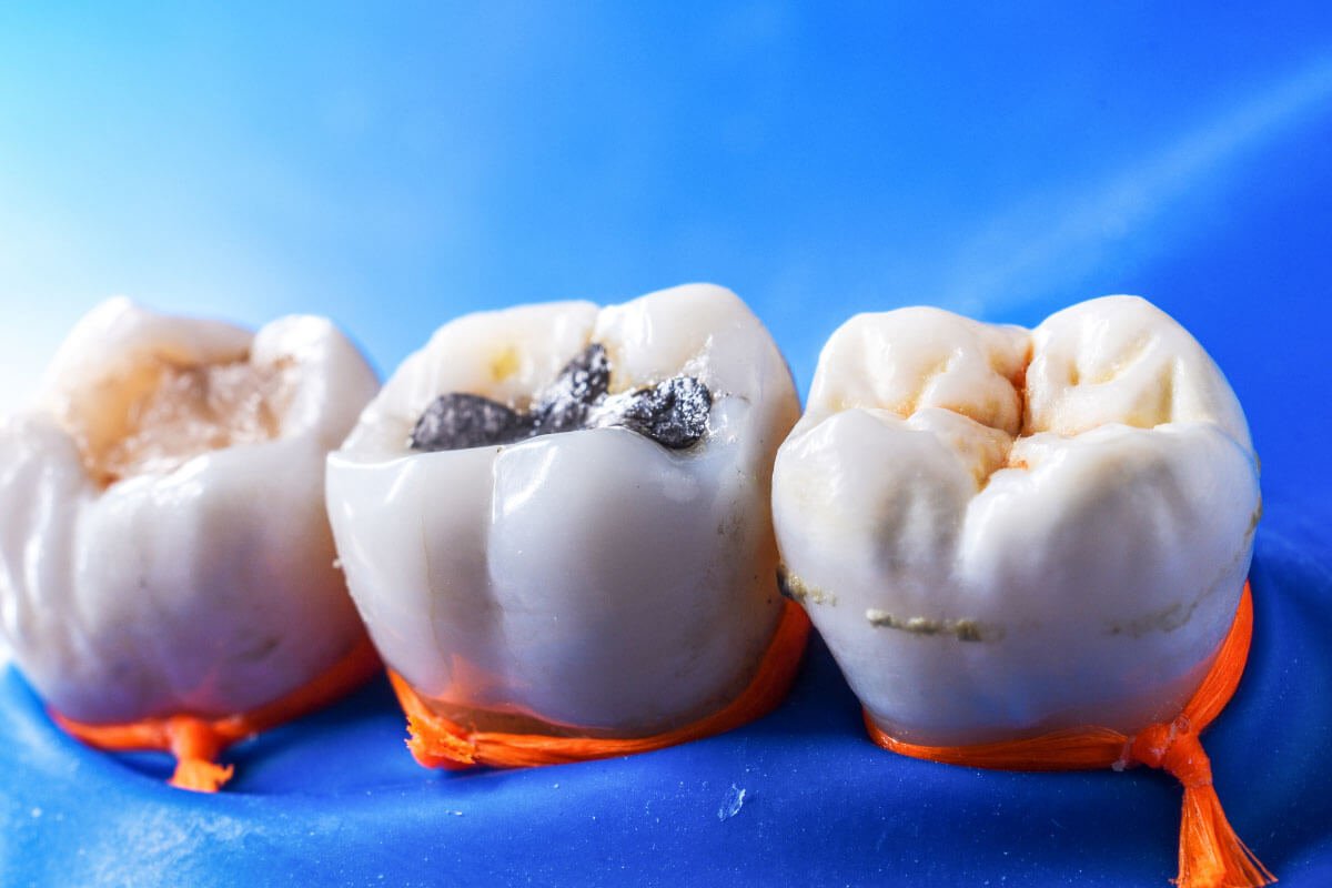 Featured image for “How to Choose the Best Dental Fillings in Norlane”