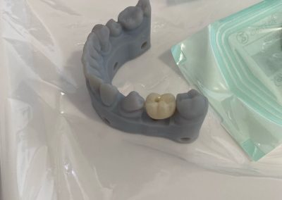 implant crown demo dentist norlane geelong
