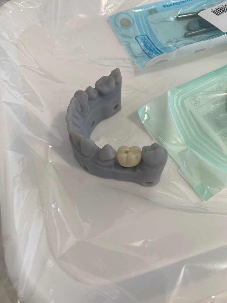 implant crown demo dentist norlane geelong