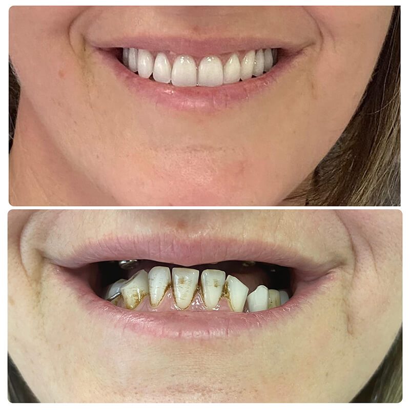 6 upper implants and a fixed upper bridge norlane geelong