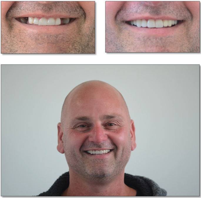 crowns and implants before and after in victoria
