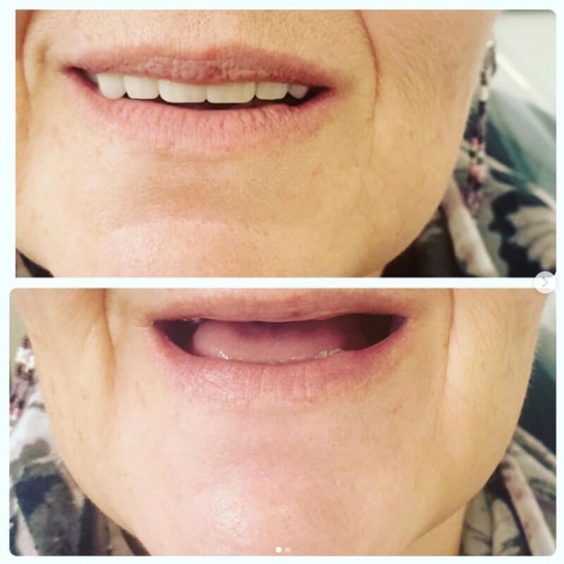 fixed bridge zirconia on 4 implants norlane geelong