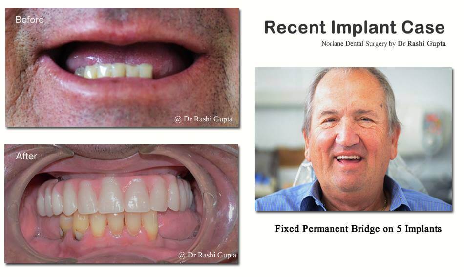 fixed permanent bridge on 5 implants before and after norlane geelong