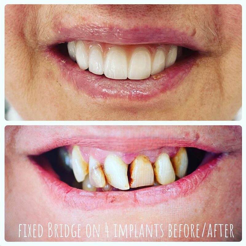 fixed temporary bridge on 4 implants norlane geelong