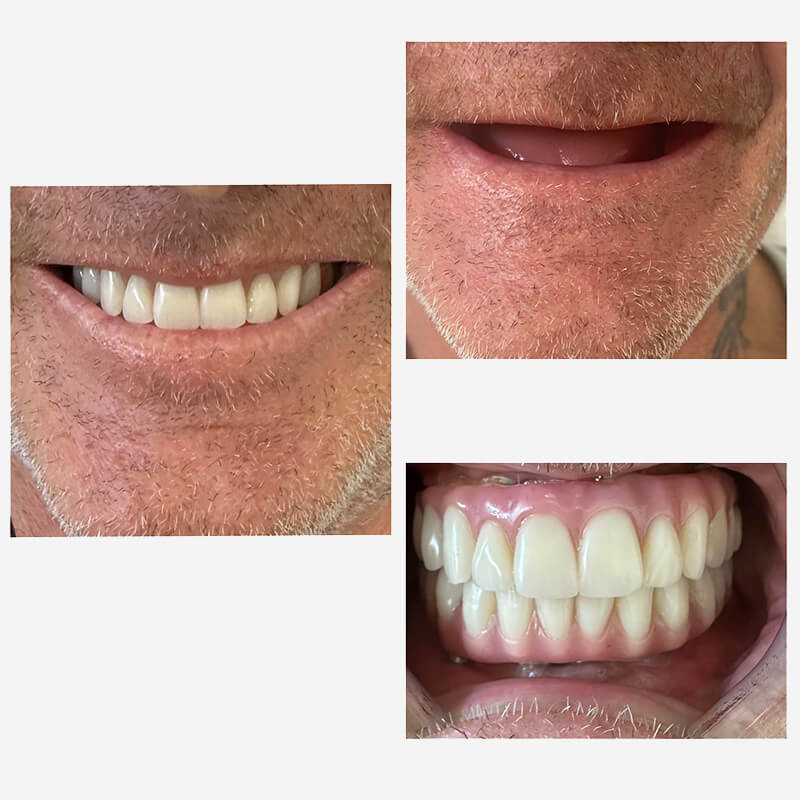 upper 4 implants and lower 6 implants with fixed bridges on the implants norlane geelong