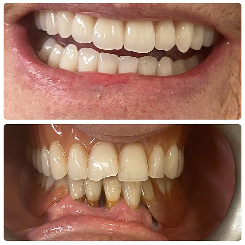 upper denture and lower fixed bridge on 4 implants norlane geelong