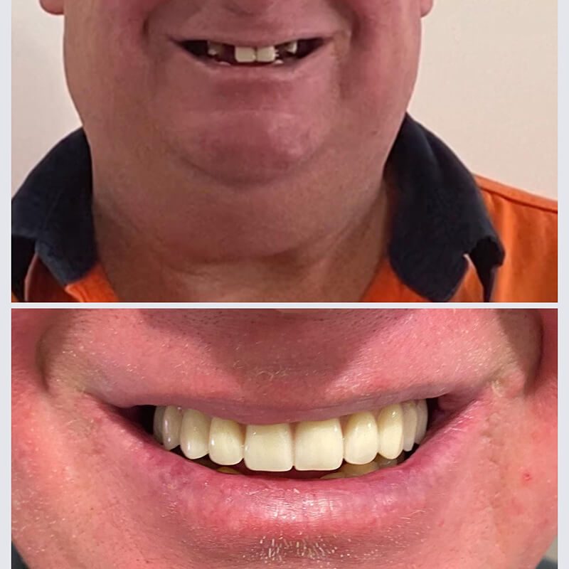 upper fixed bridge on 5 implants norlane geelong