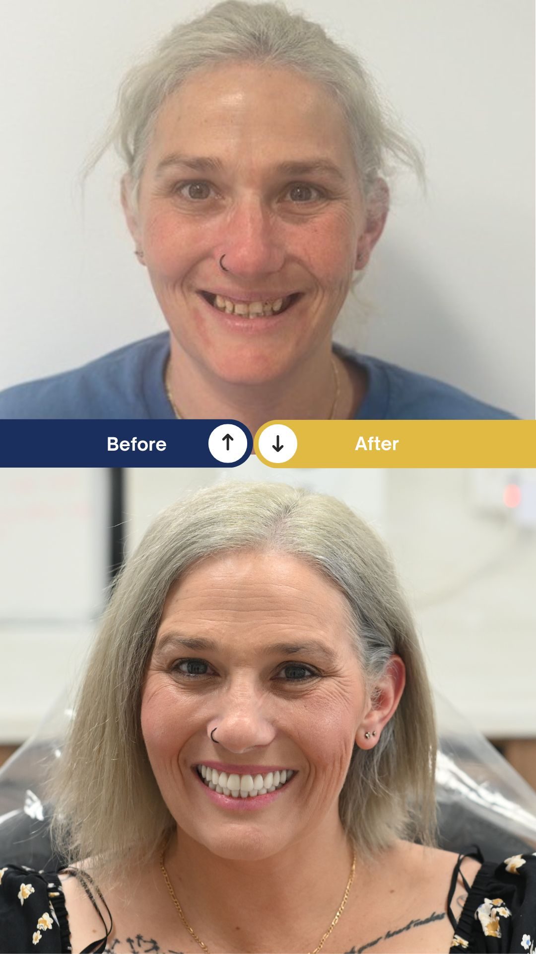 Barbara - All-On-X Dental Implants - Before and After Barbara - All-On-X Dental Implants - Before and After
