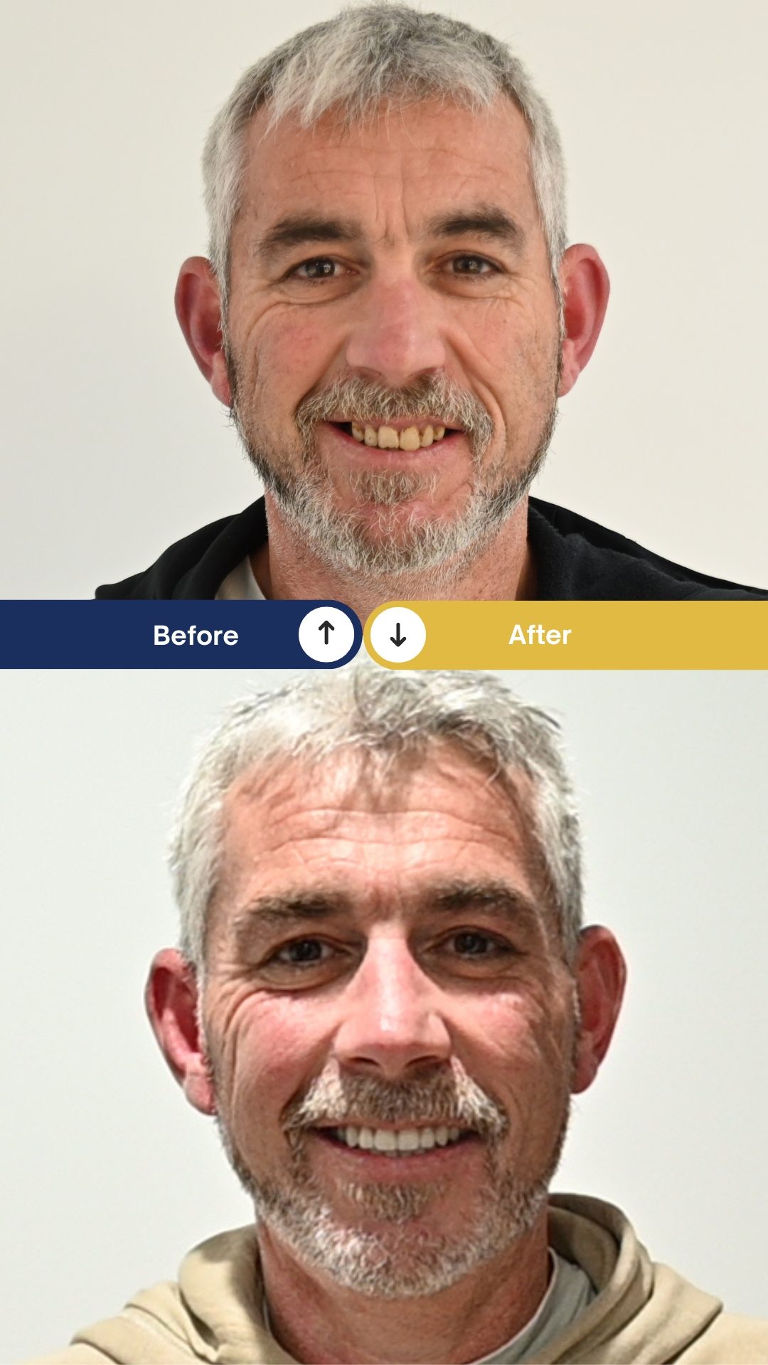 David - All-On-X Dental Implants - Before and After David - All-On-X Dental Implants - Before and After