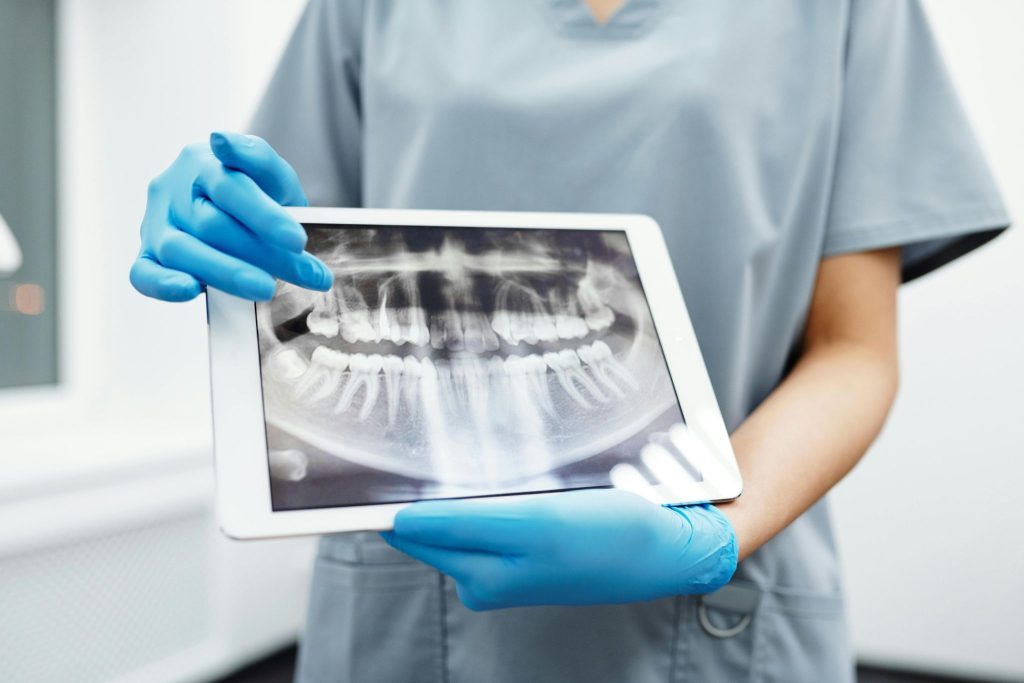 Dental Crowns and Bridges