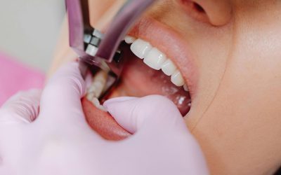 Norlane Dental Wisdom Teeth Removal – Safe & Gentle Care